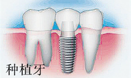 深圳種植牙