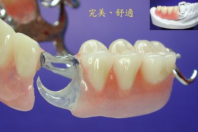 鑲假牙選擇塑料牙托好還是鋼托好？