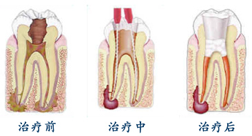 根管治療結果圖
