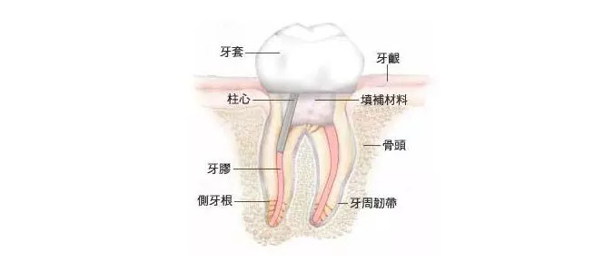 根管治療後做牙冠多少錢