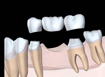 假牙哪個(ge) 好之烤瓷牙
