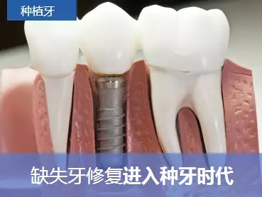 假牙哪個好之種植牙