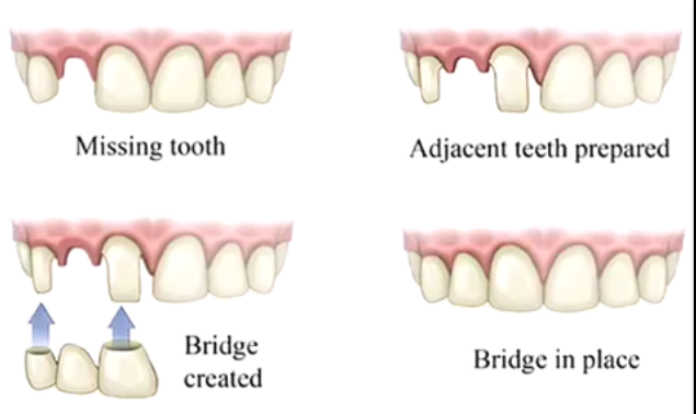 深圳美齒冠要多少錢