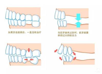 牙齒缺失的危害