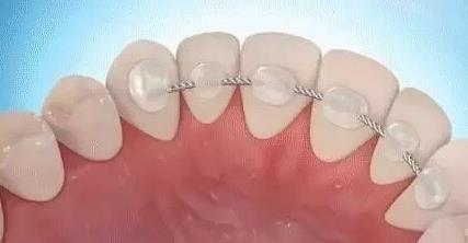 舌側(ce) 絲(si) 保持器多少錢