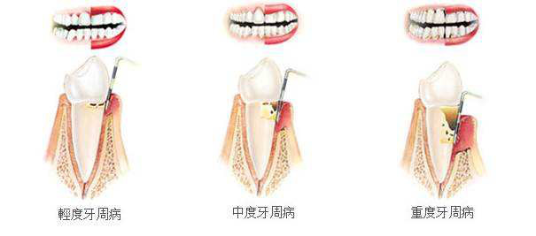 牙周病的症狀和治療