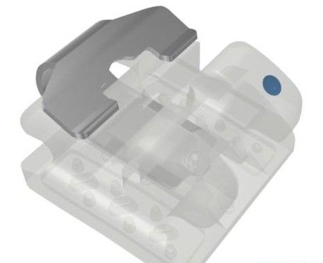 陶瓷自鎖牙套結果