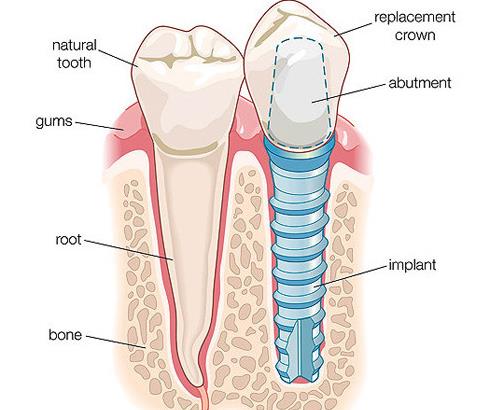 種植牙的種類與(yu) 價(jia) 格