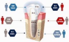 瑞典諾貝爾種植體(ti) 