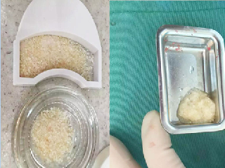 牙齒植骨骨粉