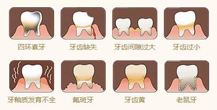 牙釉質發育不全