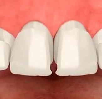 牙齒貼麵做了之後怎麽(me) 才不會(hui) 掉