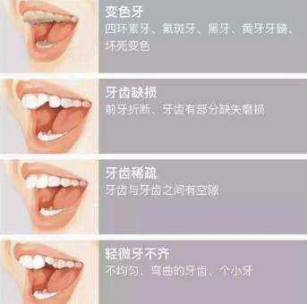 牙齒貼麵的副作用