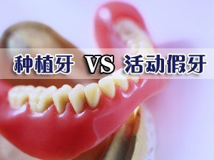 種植牙和傳(chuan) 統假牙的區別