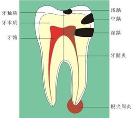 牙齒齲壞太深做根管治療