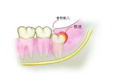 為(wei) 什麽(me) 拔牙的較佳時間是上午