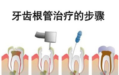 根管治療