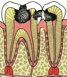 蛀牙疼是傷(shang) 到牙神經