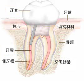 蛀牙疼傷(shang) 到牙神經了怎麽(me) 辦