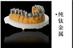 純鈦烤瓷冠