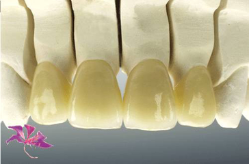 後牙烤瓷牙材料