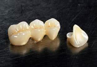 鈦合金牙多少錢