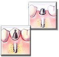 種植牙多久裝牙冠