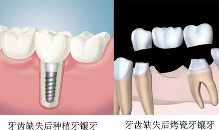 牙齒固定修複方式