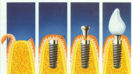 滿口假牙多少錢