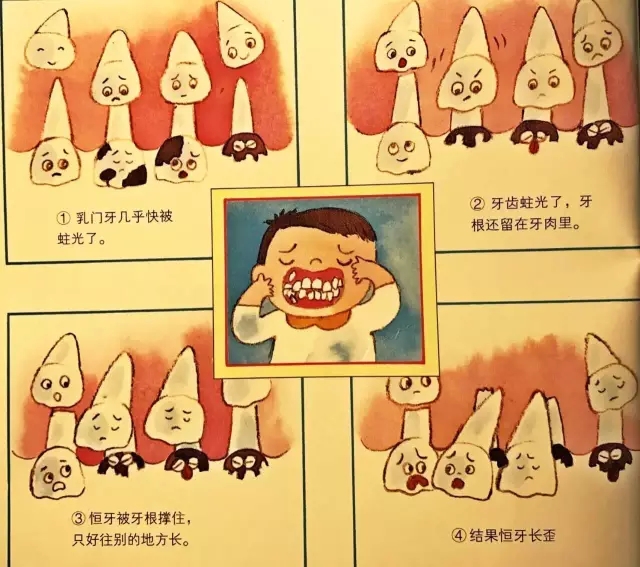 乳牙蛀壞的後果