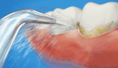 基礎款——洗牙