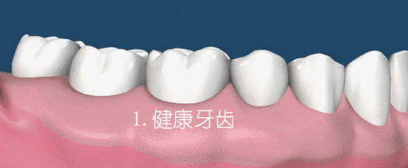 牙周炎症狀圖片