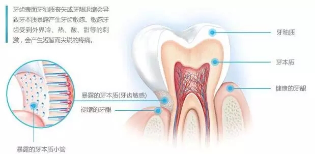 牙齒酸痛是怎麽(me) 回事