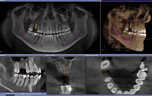 為(wei) 什麽(me) 要做種植牙方案