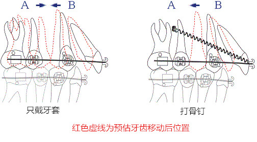 矯正牙齒打種植釘的作用