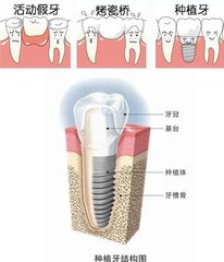 裝假牙可以報銷嗎