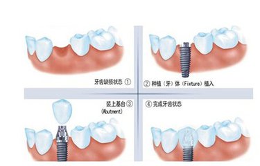 種植牙手術後注意事項