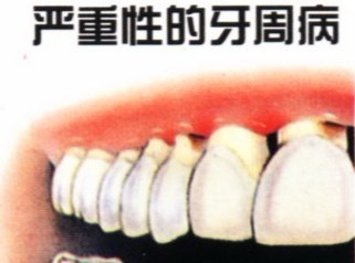 牙齦萎縮的原因牙周病