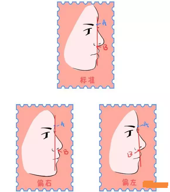 判斷骨性齙牙和牙性齙牙