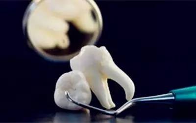 拔牙真的不痛嗎