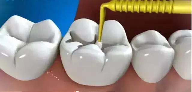 補牙需要幾次完成幾天