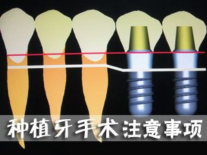 種植牙術後注意事項