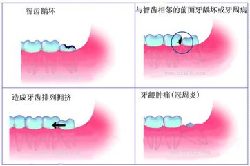 什麽(me) 時候拔牙好