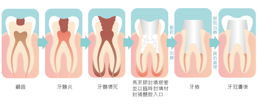 根管治療後延長壽命的辦法