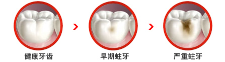 導致蛀牙的原因