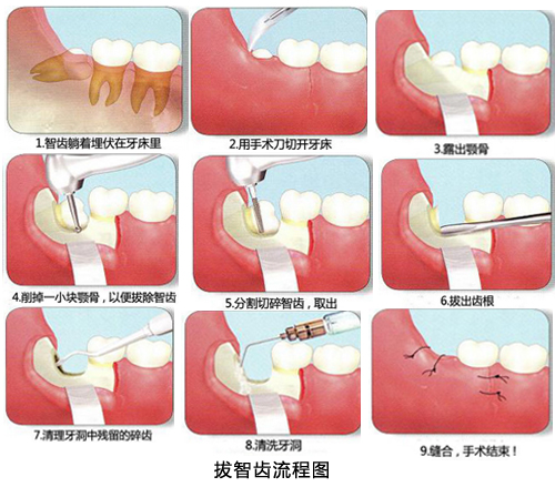 拔智齒的具體(ti) 過程圖