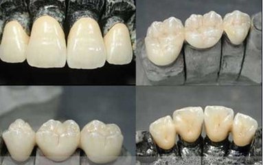 合金烤瓷牙好不好