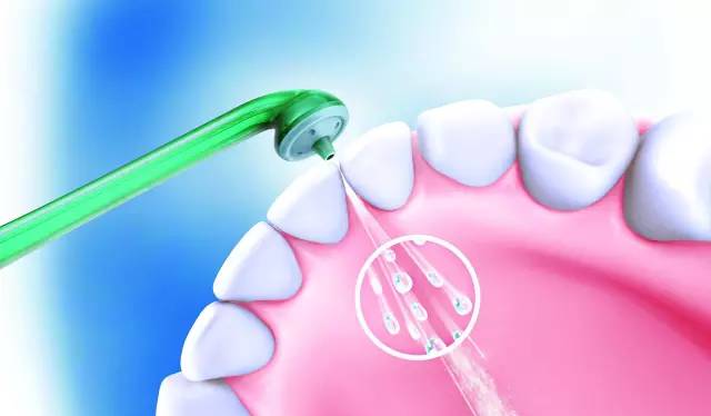 超聲筆洗牙去除牙結石