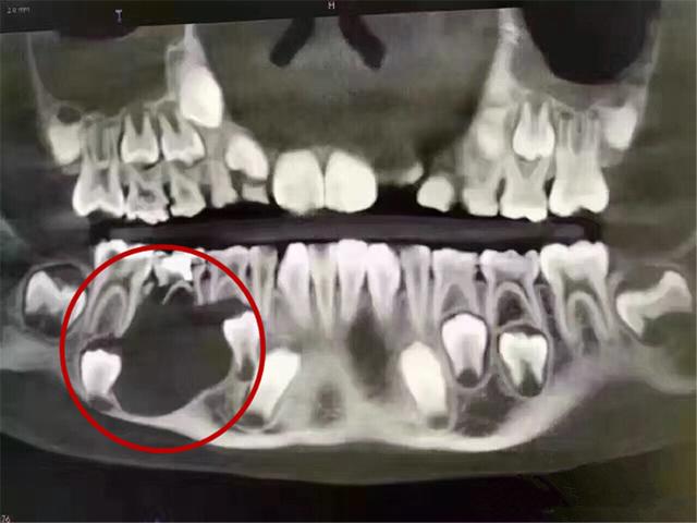 兒(er) 童x光牙片圖