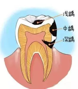蛀牙可以一次補完嗎